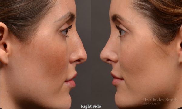 Rhinoplasty, Septoplasty - Rhinoplasty Before and After – Case 490
