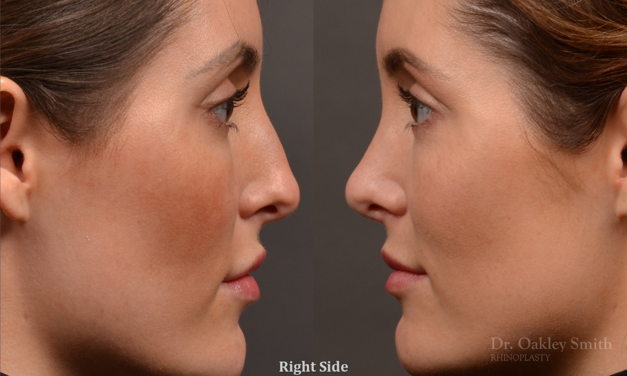 Rhinoplasty, Septoplasty - Rhinoplasty Before and After – Case 490