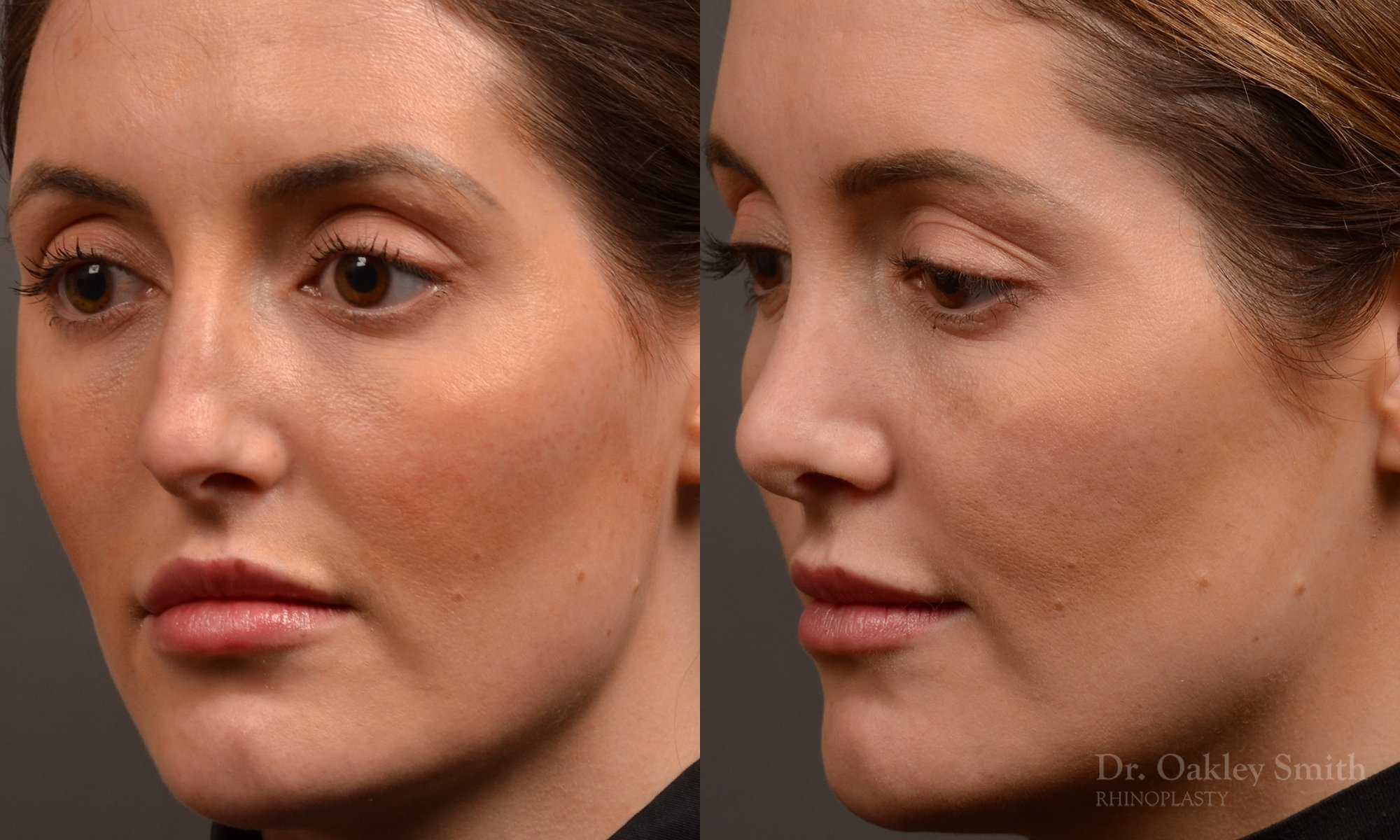 Rhinoplasty, Septoplasty - Rhinoplasty Before and After – Case 490