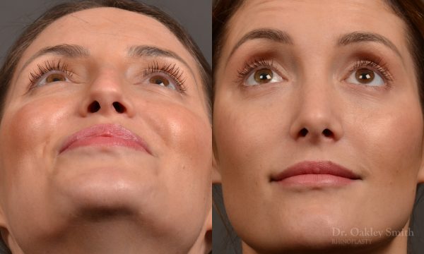 Rhinoplasty, Septoplasty - Rhinoplasty Before and After – Case 490