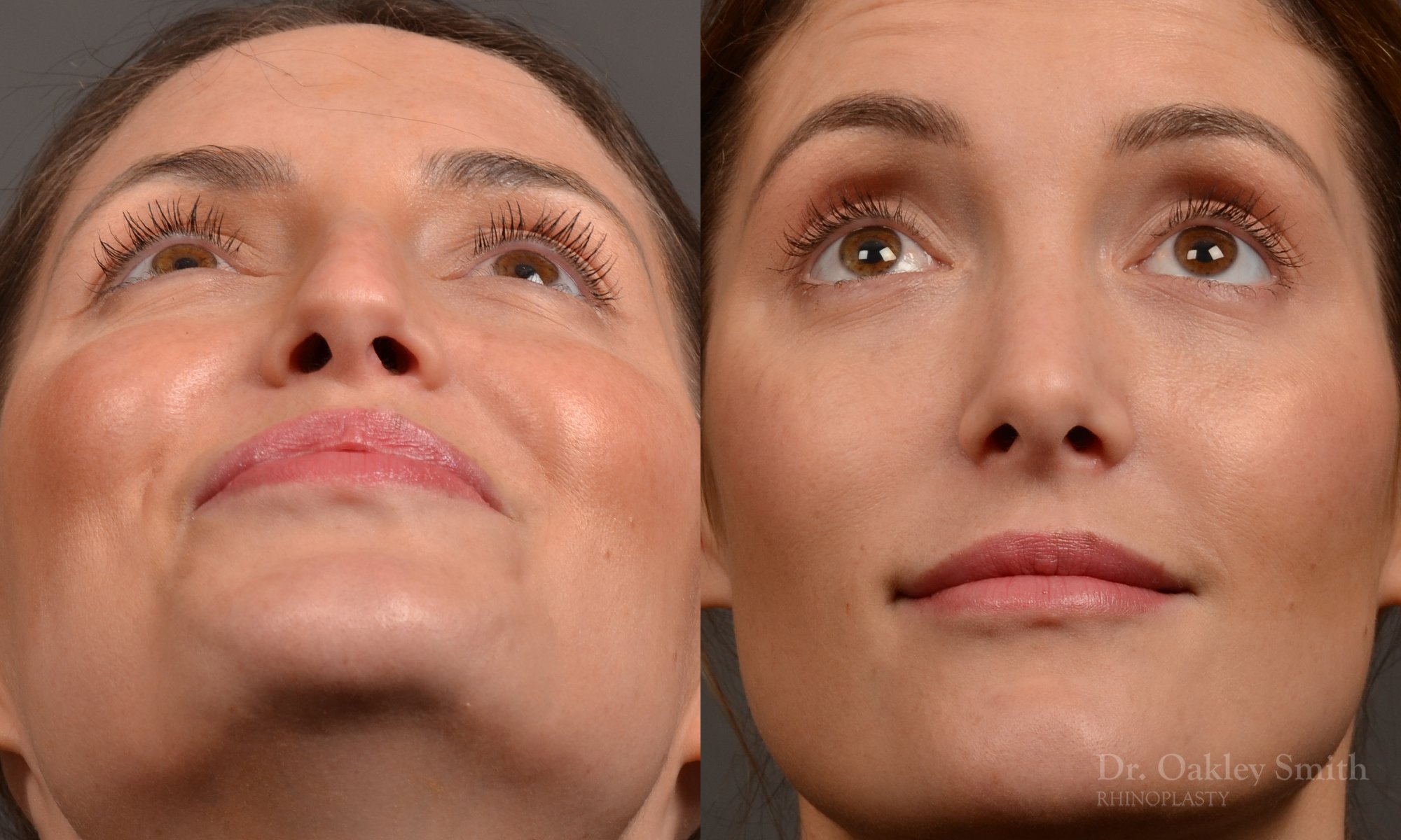 Rhinoplasty, Septoplasty - Rhinoplasty Before and After – Case 490