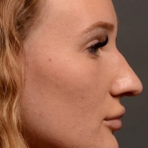 Rhinoplasty - Rhinoplasty Before and After – Case 491
