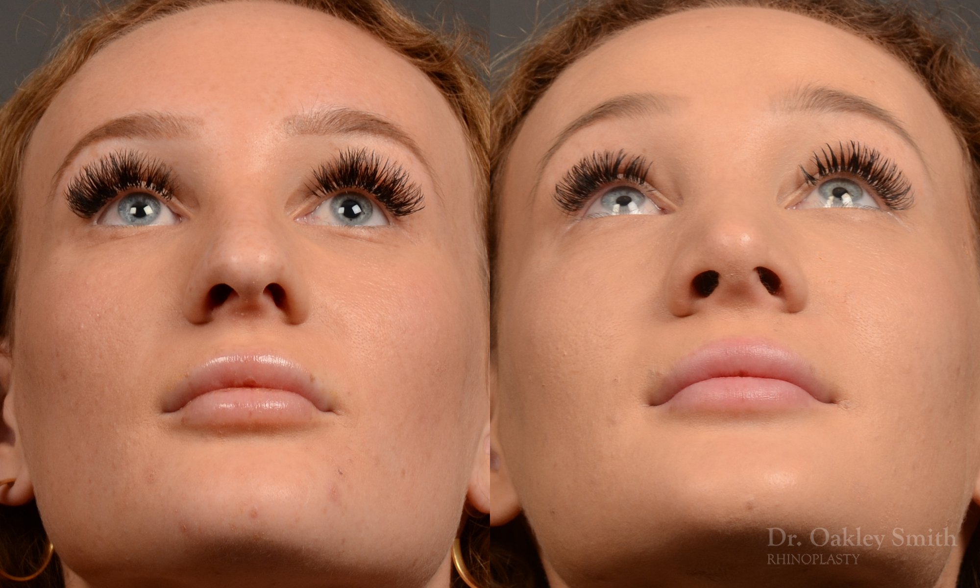 Rhinoplasty - Rhinoplasty Before and After – Case 491