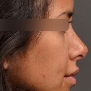 Revision Rhinoplasty - Rhinoplasty Before and After – Case 492