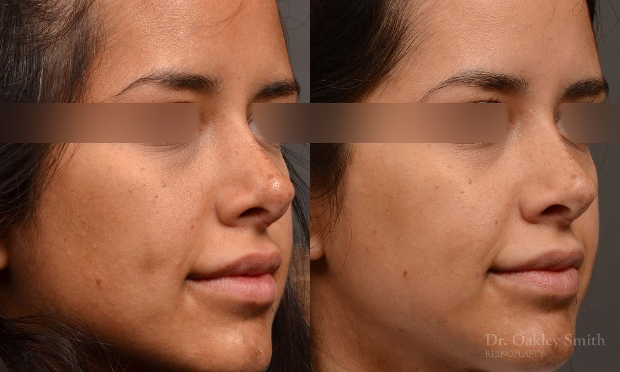 Revision Rhinoplasty - Rhinoplasty Before and After – Case 492