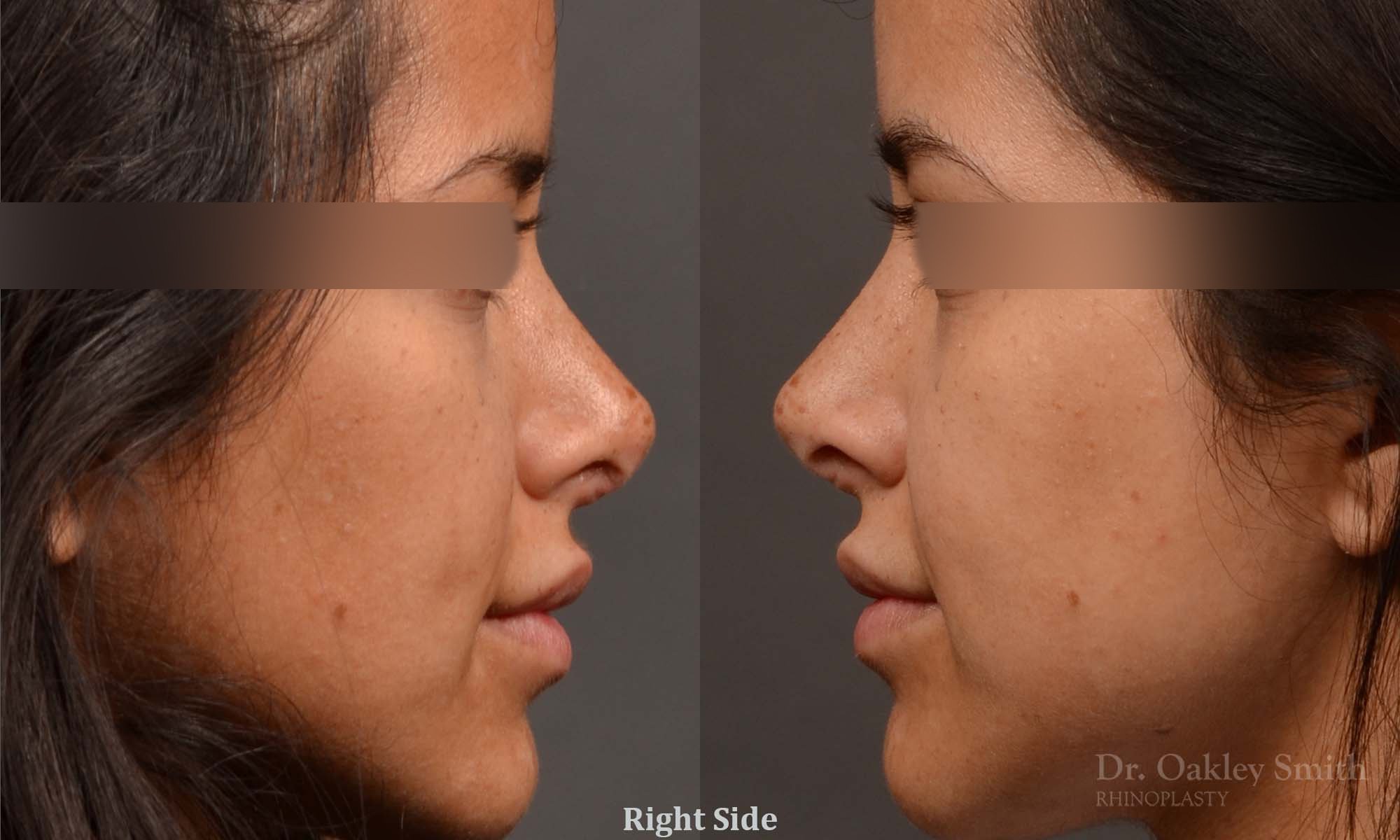Revision Rhinoplasty - Rhinoplasty Before and After – Case 492