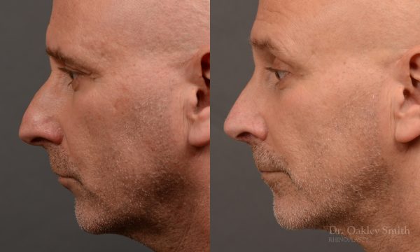 Rhinoplasty - Rhinoplasty Before and After – Case 493