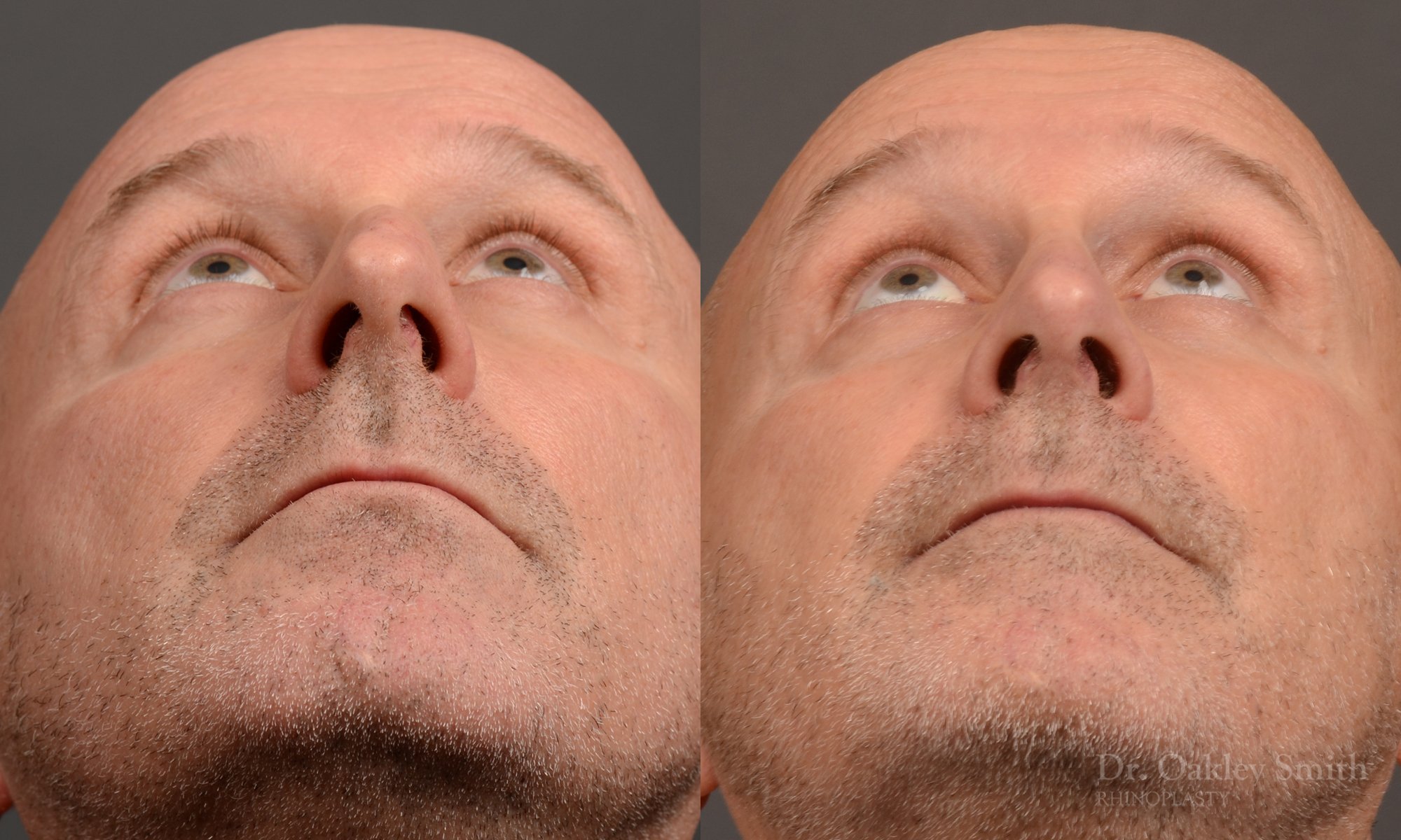 Rhinoplasty - Rhinoplasty Before and After – Case 493