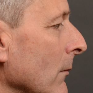 Rhinoplasty - Rhinoplasty Before and After – Case 494