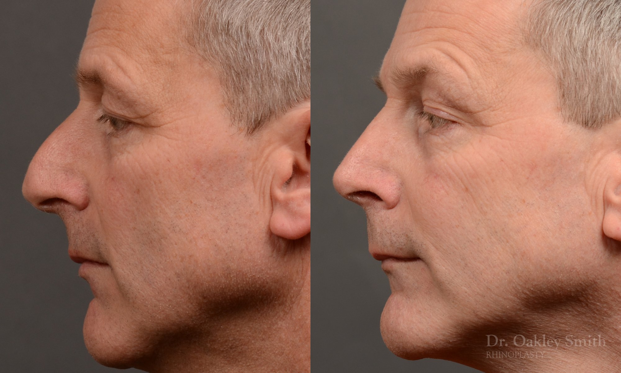 Rhinoplasty - Rhinoplasty Before and After – Case 494