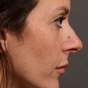 Rhinoplasty - Rhinoplasty Before and After – Case 495