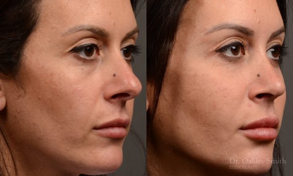 Rhinoplasty - Rhinoplasty Before and After – Case 495