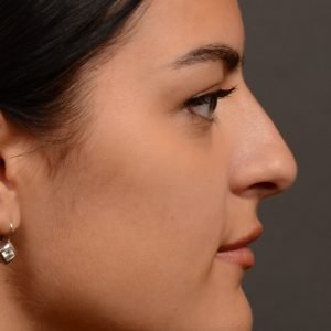 Rhinoplasty - Rhinoplasty Before and After – Case 496