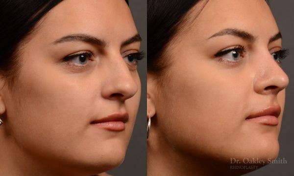 Rhinoplasty - Rhinoplasty Before and After – Case 496