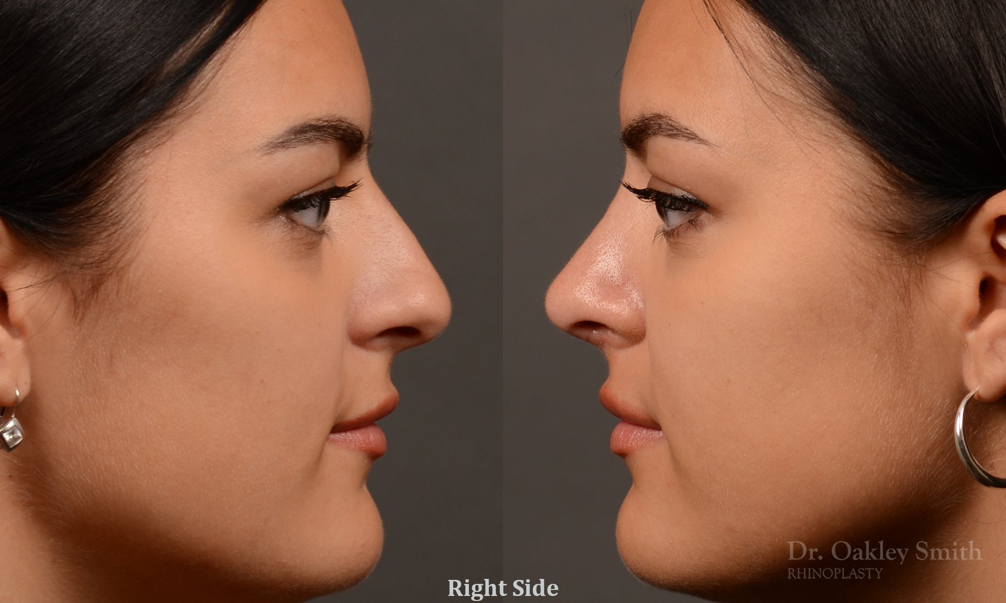Rhinoplasty - Rhinoplasty Before and After – Case 496