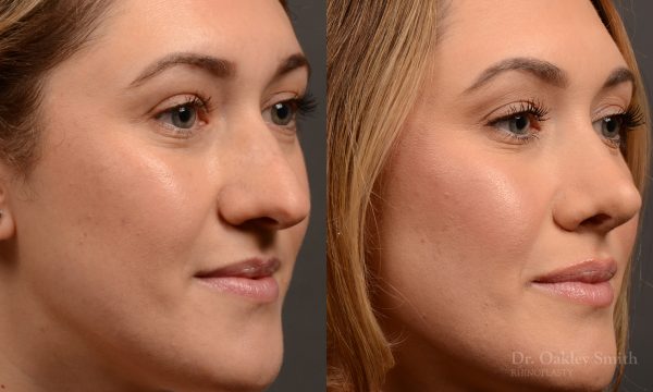 Rhinoplasty - Rhinoplasty Before and After – Case 497
