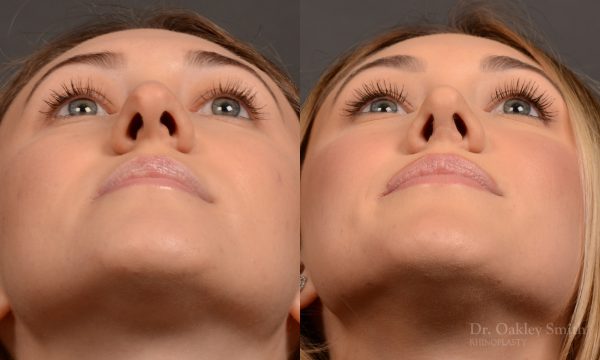 Rhinoplasty - Rhinoplasty Before and After – Case 497