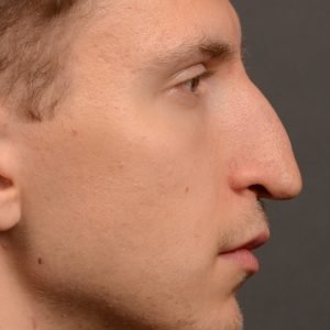 Rhinoplasty, Septoplasty - Rhinoplasty Before and After – Case 498