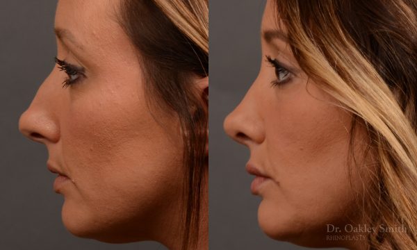 Rhinoplasty - Rhinoplasty Before and After – Case 499