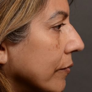 Rhinoplasty - Rhinoplasty Before and After – Case 500