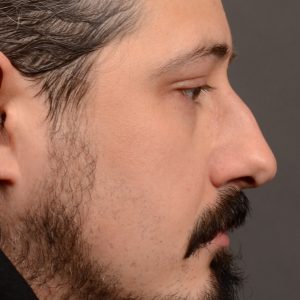 Rhinoplasty - Rhinoplasty Before and After – Case 501