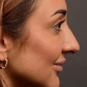 Rhinoplasty - Rhinoplasty Before and After – Case 502