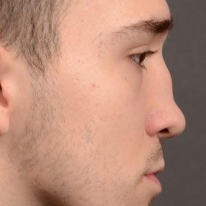 Rhinoplasty, Septoplasty - Rhinoplasty Before and After – Case 503