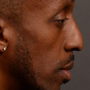 Rhinoplasty, Septoplasty - Septoplasty Before and After –  Case 504