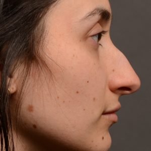 Rhinoplasty - Rhinoplasty Before and After – Case 506