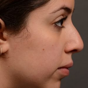 Rhinoplasty - Rhinoplasty Before and After – Case 507