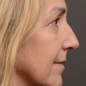 Rhinoplasty - Rhinoplasty Before and After – Case 510