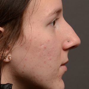 Rhinoplasty - Rhinoplasty Before and After – Case 511