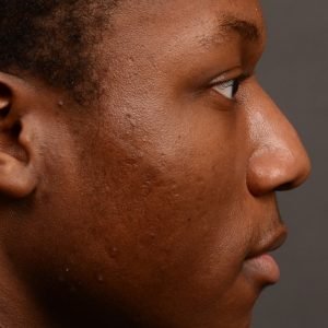 Rhinoplasty - Rhinoplasty Before and After – Case 515