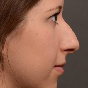 Rhinoplasty - Rhinoplasty Before and After – Case 516