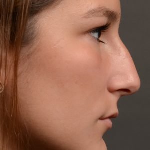 Rhinoplasty - Rhinoplasty Before and After – Case 517