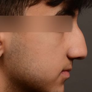 Rhinoplasty - Rhinoplasty Before and After – Case 520
