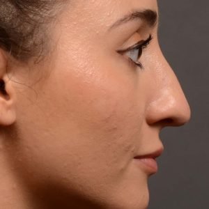 Rhinoplasty - Rhinoplasty Before and After – Case 522