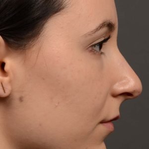 Revision Rhinoplasty - Revision Rhinoplasty Before and After – Case 449.1