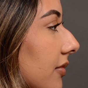 Rhinoplasty - Rhinoplasty Before and After – Case 523
