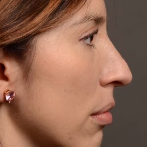 Rhinoplasty - Rhinoplasty Before and After – Case 525