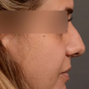 Rhinoplasty - Rhinoplasty Before and After – Case 527