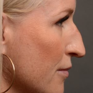 Rhinoplasty - Rhinoplasty Before and After – Case 528