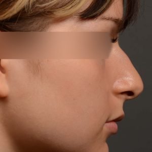 Revision Rhinoplasty, Rhinoplasty - Rhinoplasty Before After – Case 530