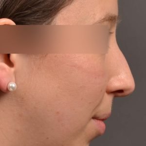 Rhinoplasty - Rhinoplasty Before and After – Case 534