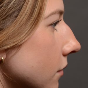 Rhinoplasty - Rhinoplasty Before and After – Case 536
