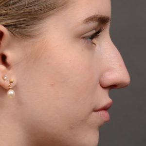 Rhinoplasty - Rhinoplasty Before and After Case 537