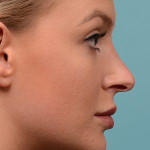 Rhinoplasty - Rhinoplasty Before and After – Case 538