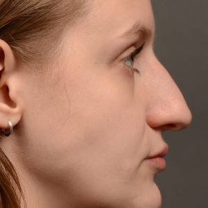 Rhinoplasty - Rhinoplasty Before and After – Case 539
