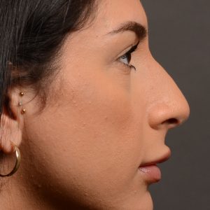 Rhinoplasty - Rhinoplasty Before and After – Case 540