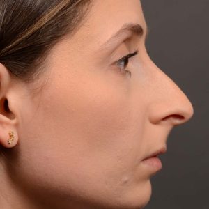 Rhinoplasty - Before and After Rhinoplasty Case 541